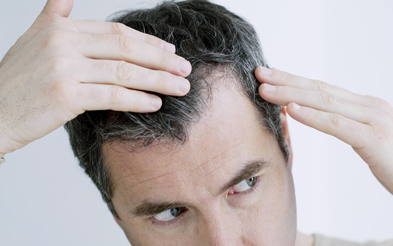 tratamiento-alopecia-hombres-zaragoza