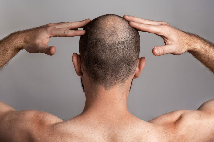 Tratamiento de la alopecia en Zaragoza