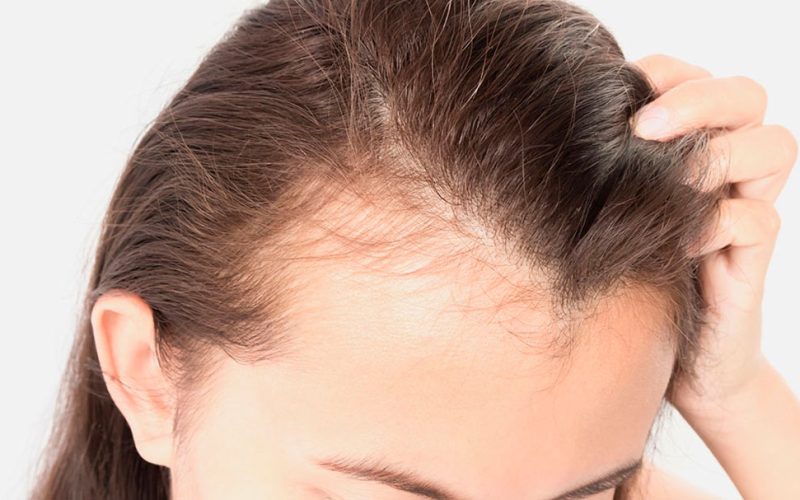 Tratamiento mesoterapia capilar