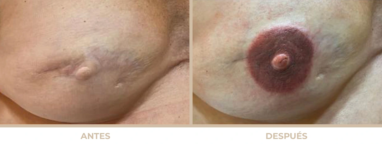 Antes y después de micropigmentación de areola