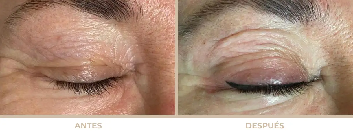 Antes y después de micropigmentación de Eye Liner