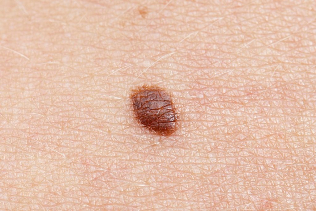 carcinoma