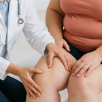 Tratamiento del lipedema Zaragoza