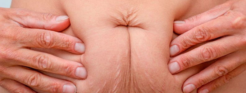 ¿Cómo eliminar la flacidez abdominal sin cirugía?