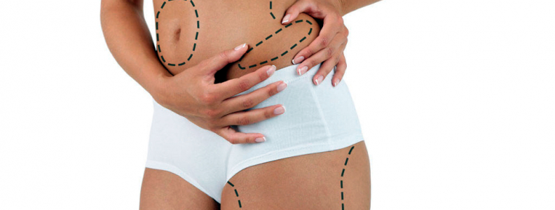 ¿Liposucción sin cirugía? ¡Es posible!