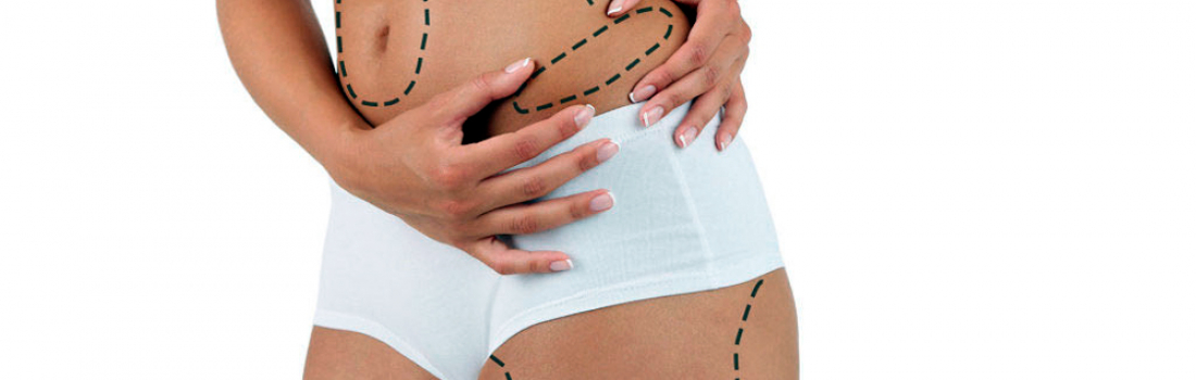 ¿Liposucción sin cirugía? ¡Es posible!