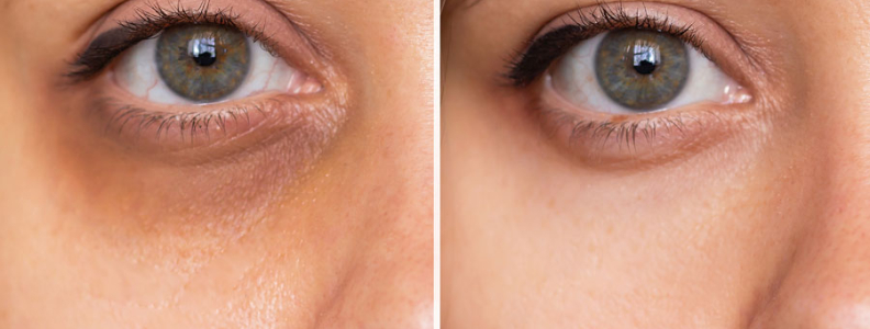 Ojeras oscuras, ¿cómo combatirlas?