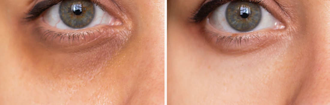 Ojeras oscuras, ¿cómo combatirlas?